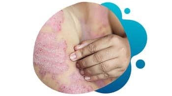 Psoriatic Arthritis- Studies – Conquest Research The arm of a person with psoriatic arthritis