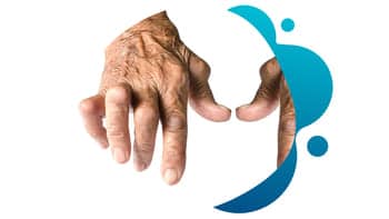 Rheumatoid Arthritis- Studies – Conquest Research The hand of a person with rheumatoid arthritis