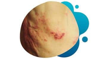 Postherpetic Neuralgia Study Knowing the signs of Neuralgia.