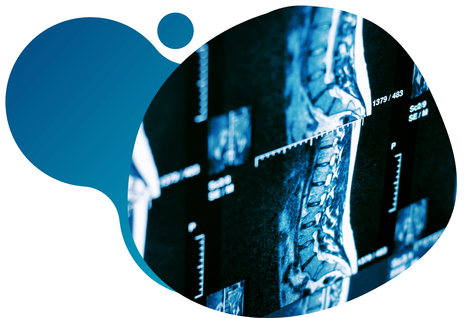 Multiple Sclerosis Clinical Studies 5