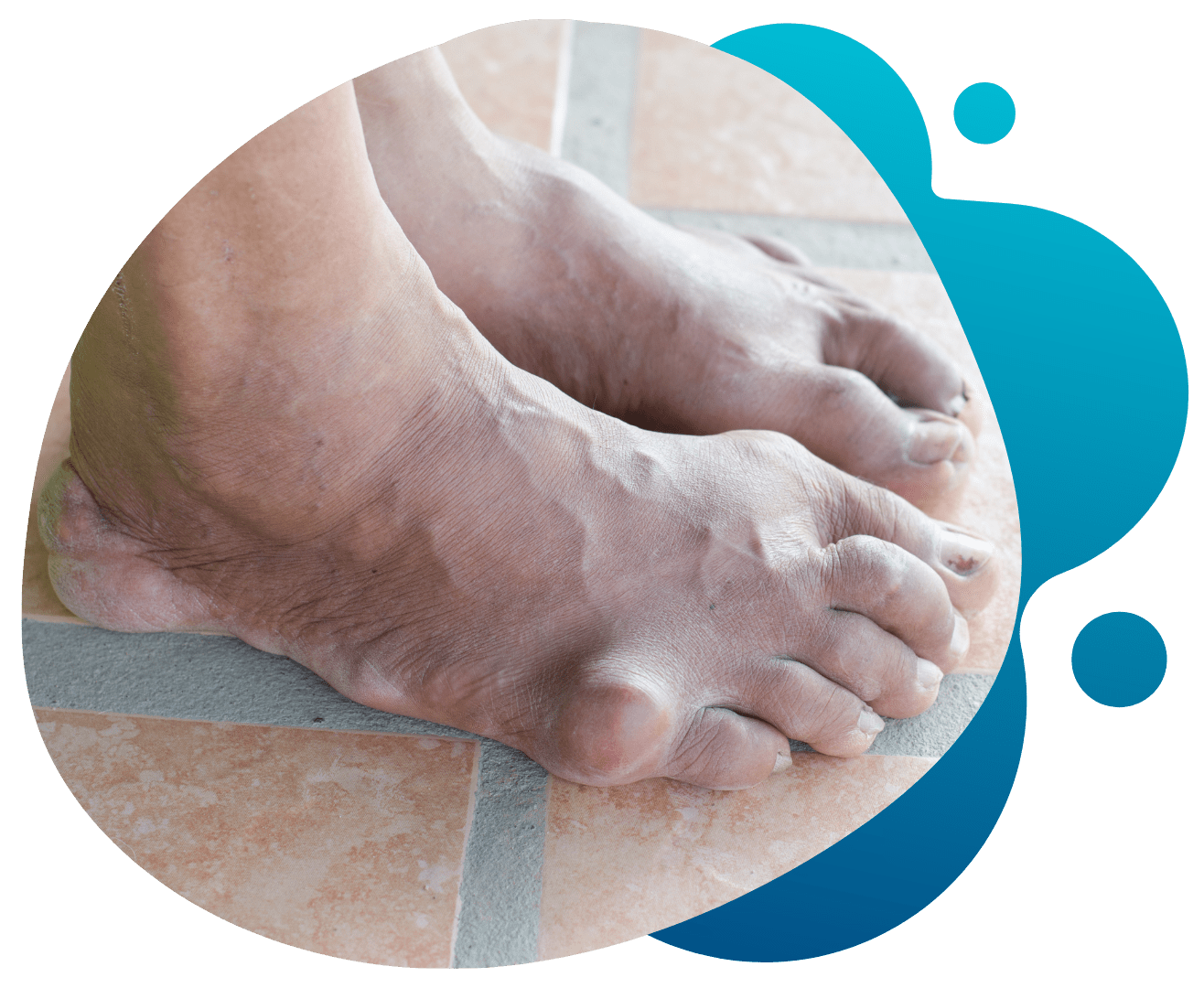 Rheumatoid Arthritis 4