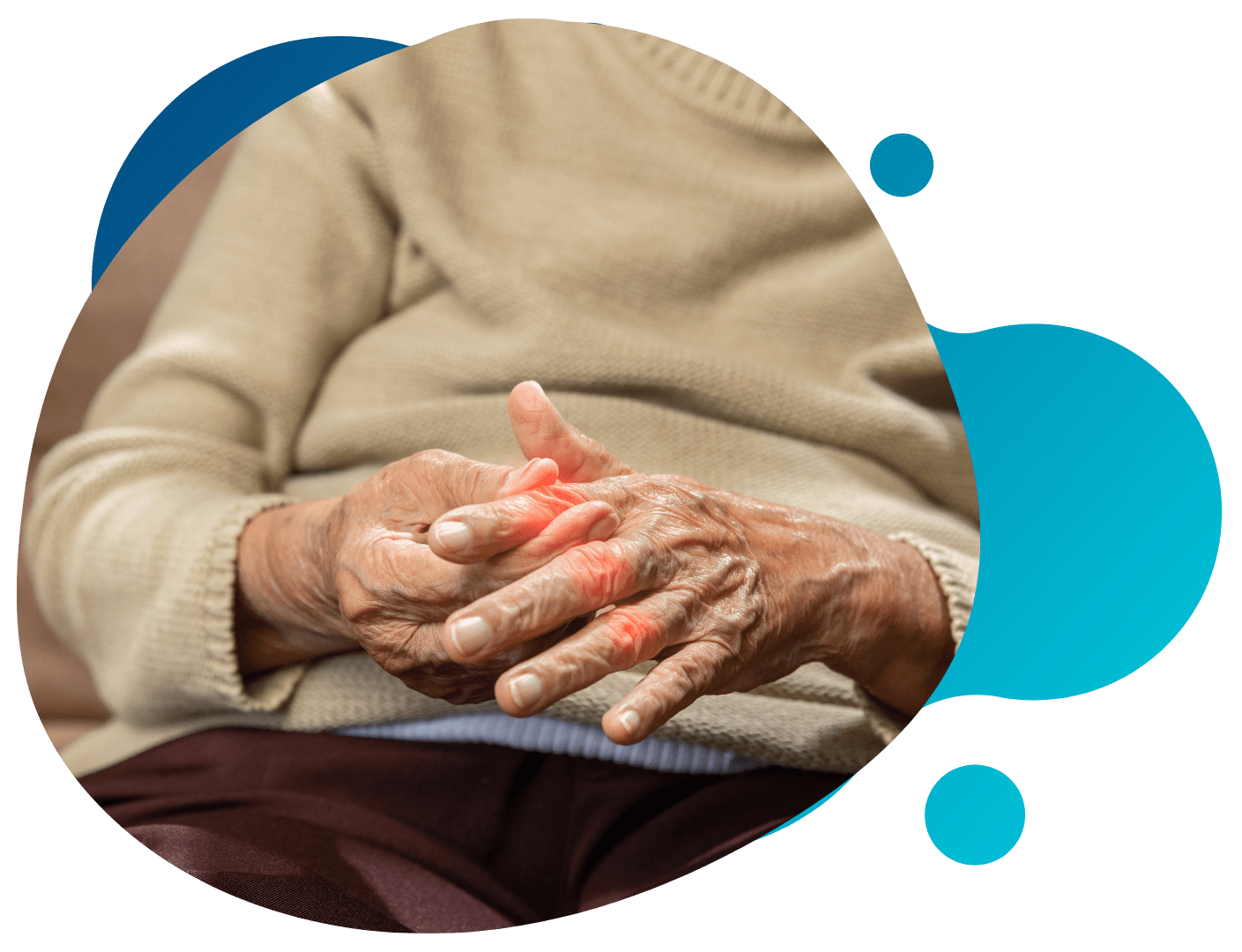 Diabetic Peripheral Neuropathy pain in the hand