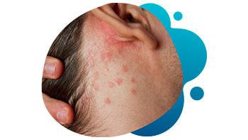 Atopic-Dermatitis-600×493 Atopic-Dermatitis