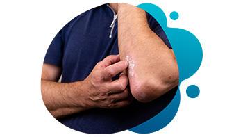 psoriasis—600×493 psoriasis