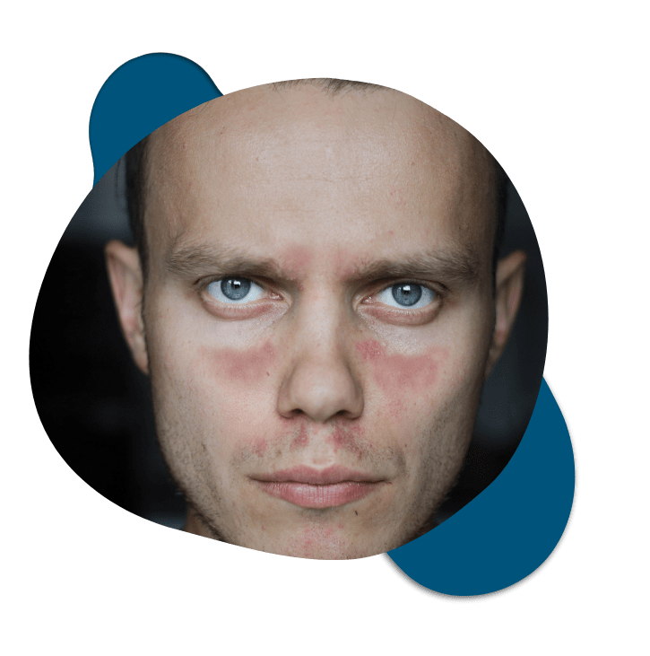 Man with butterfly-shaped facial rash from autoimmune disorder