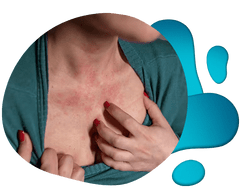 Website Elements woman scratching hives on chest