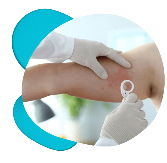 zoom in of doctor holding magnifying glass to patient with hives arms