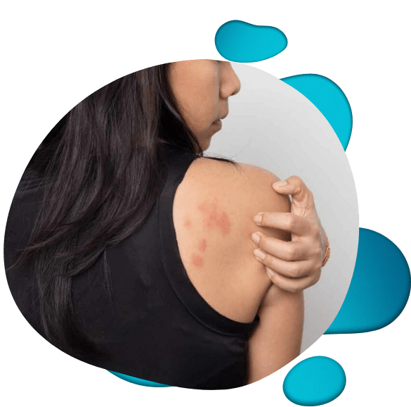 woman scratching hives on back