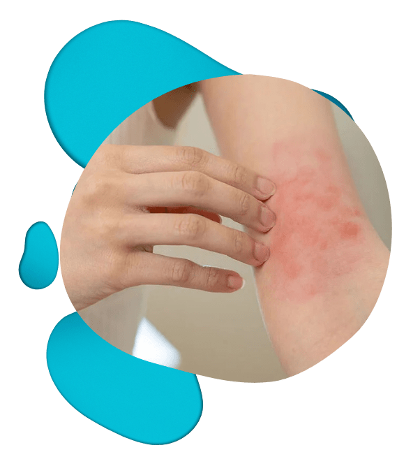 Smiling woman scratching itchy forearm